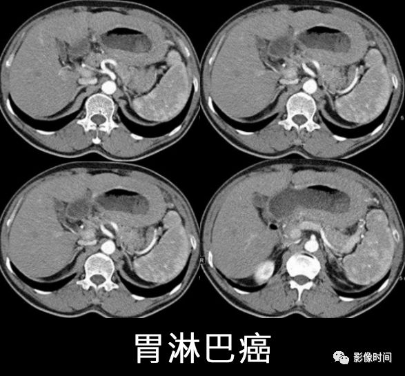 胃神经鞘瘤的 CT表现 胃神经鞘瘤的 CT表现