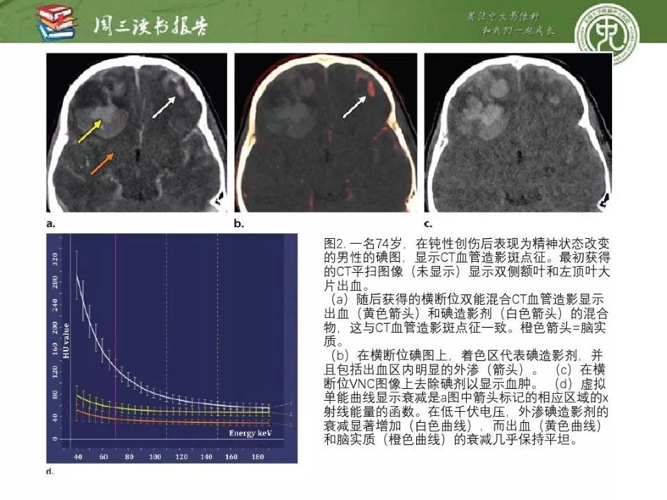 【PPT】急诊神经影像的双能CT成像