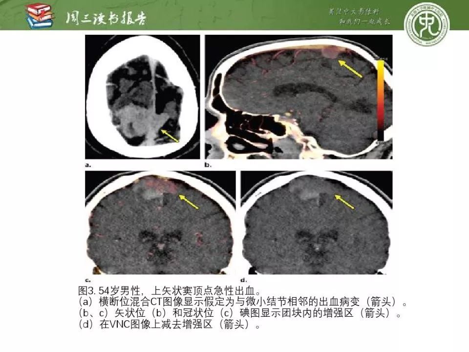 【PPT】急诊神经影像的双能CT成像