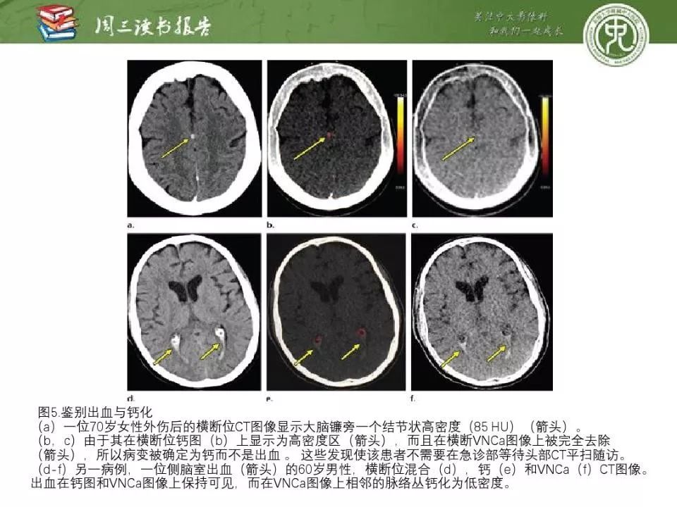 【PPT】急诊神经影像的双能CT成像