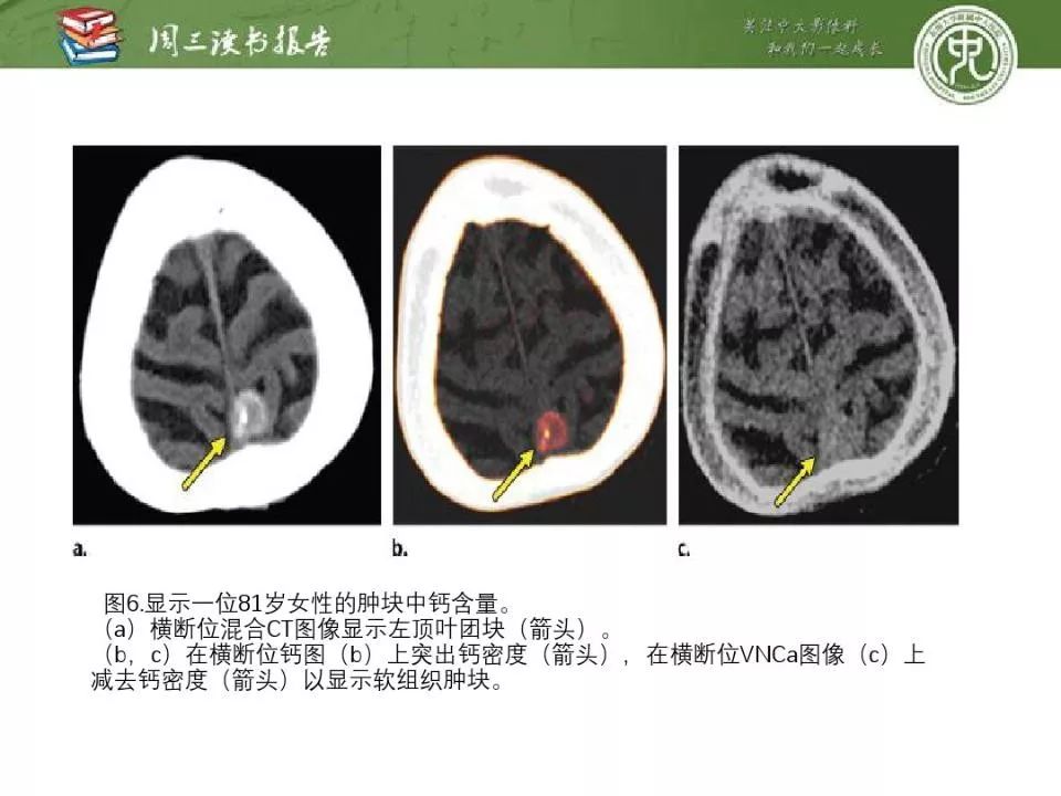 【PPT】急诊神经影像的双能CT成像