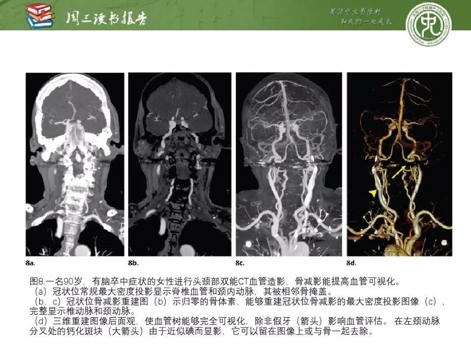 【PPT】急诊神经影像的双能CT成像