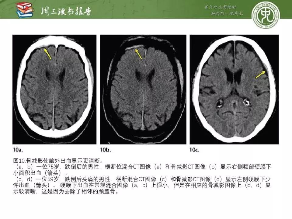 【PPT】急诊神经影像的双能CT成像