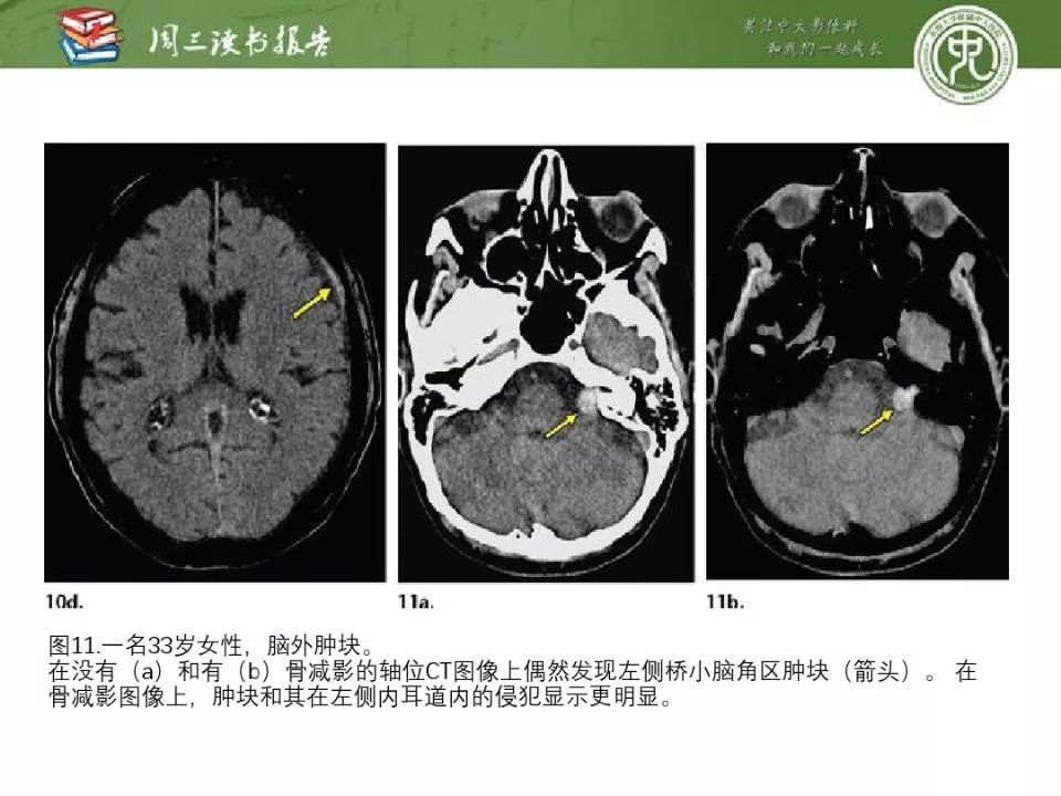 【PPT】急诊神经影像的双能CT成像
