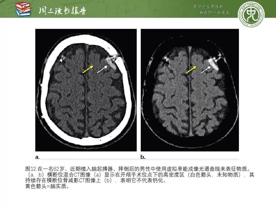 【PPT】急诊神经影像的双能CT成像