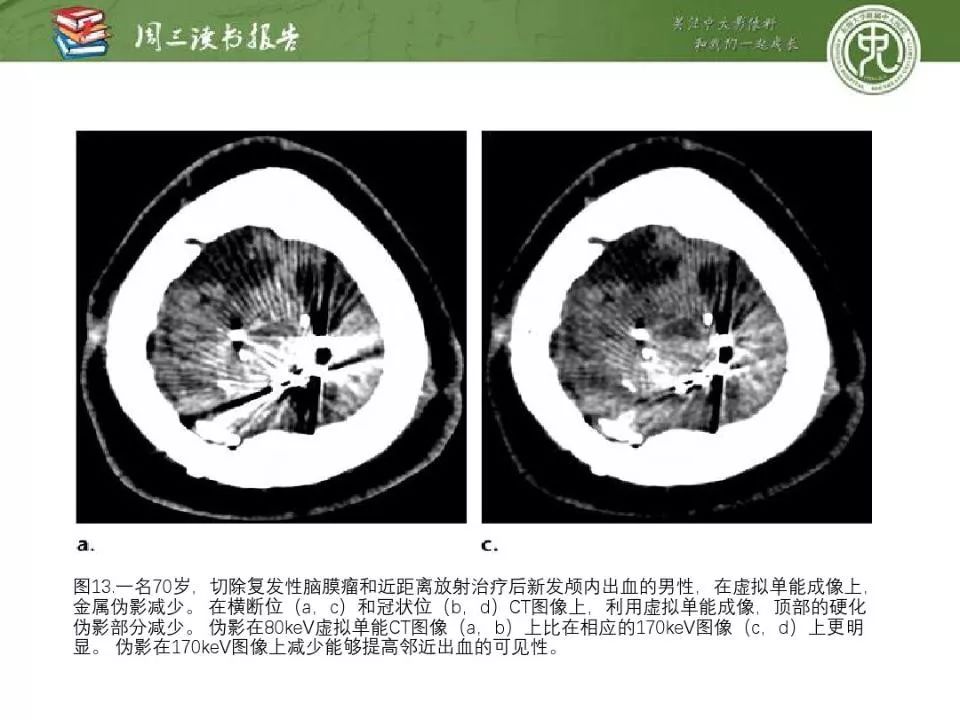 【PPT】急诊神经影像的双能CT成像