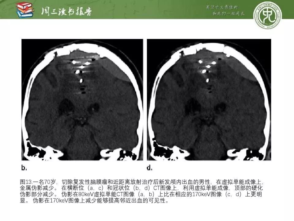 【PPT】急诊神经影像的双能CT成像