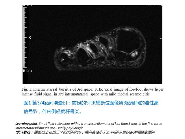 【PPT】前足底痛的MRI诊断
