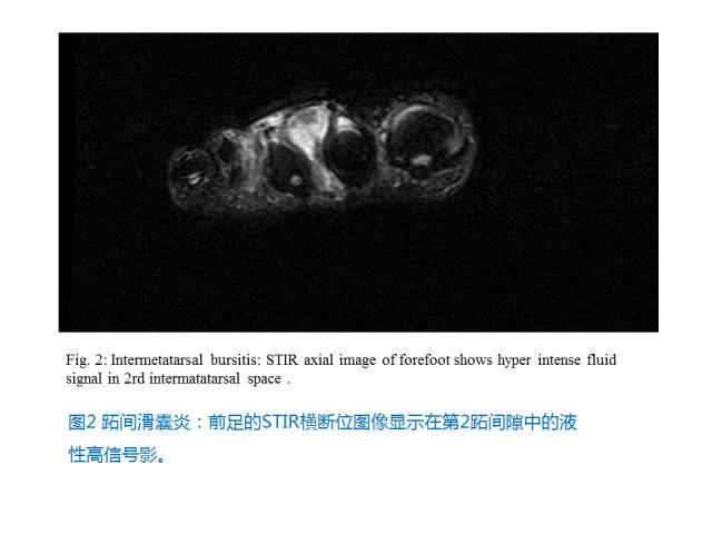 【PPT】前足底痛的MRI诊断