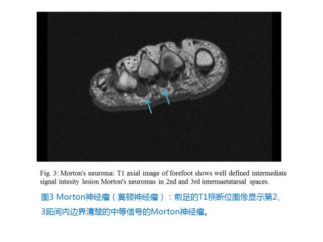 【PPT】前足底痛的MRI诊断