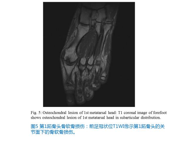 【PPT】前足底痛的MRI诊断
