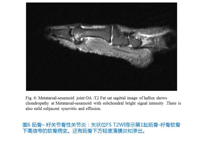 【PPT】前足底痛的MRI诊断