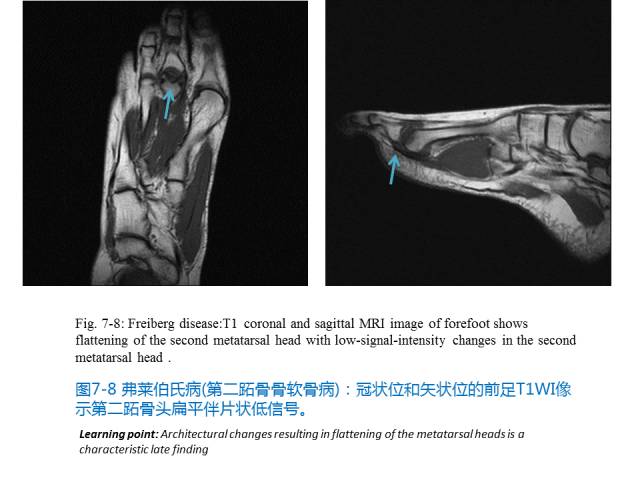 【PPT】前足底痛的MRI诊断