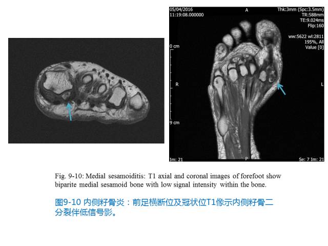 【PPT】前足底痛的MRI诊断