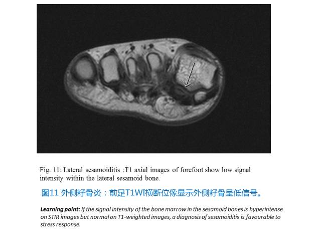 【PPT】前足底痛的MRI诊断