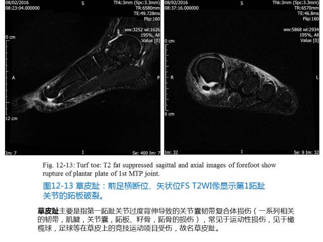 【PPT】前足底痛的MRI诊断