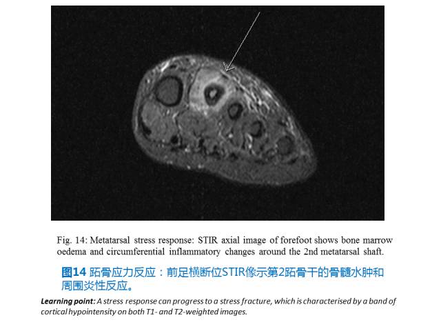 【PPT】前足底痛的MRI诊断
