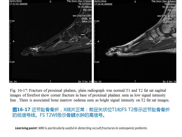 【PPT】前足底痛的MRI诊断