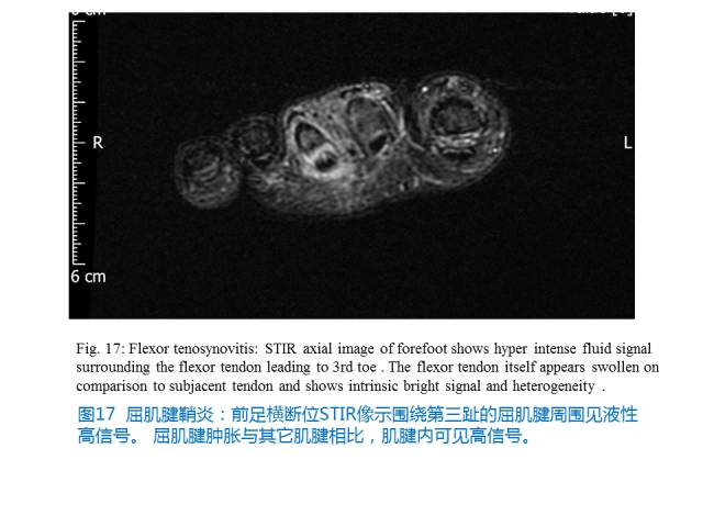 【PPT】前足底痛的MRI诊断