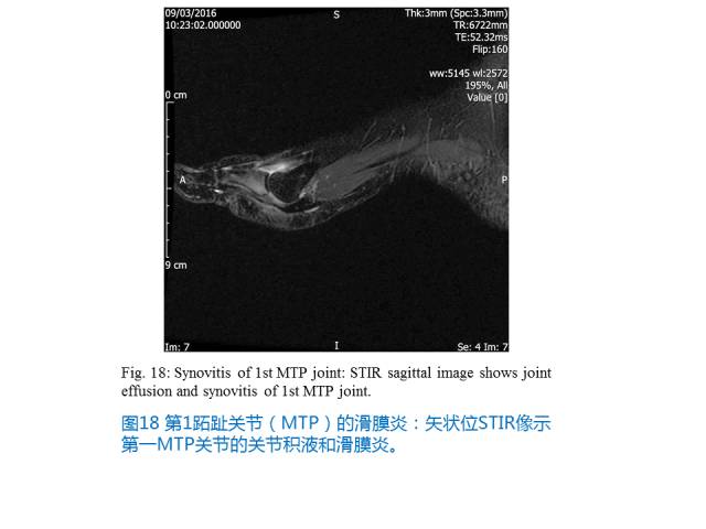 【PPT】前足底痛的MRI诊断