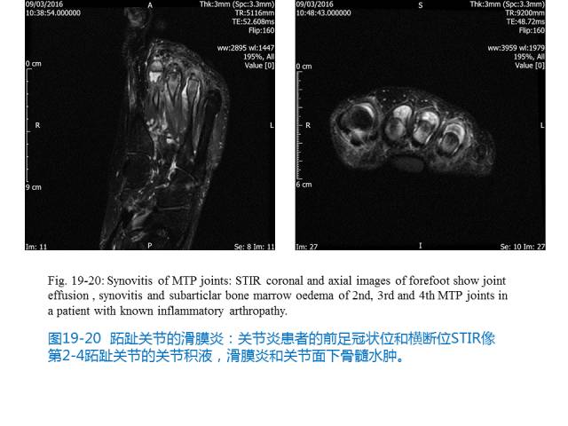 【PPT】前足底痛的MRI诊断