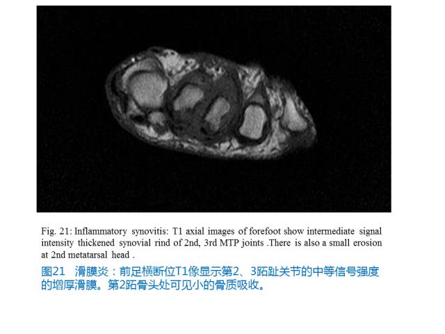 【PPT】前足底痛的MRI诊断