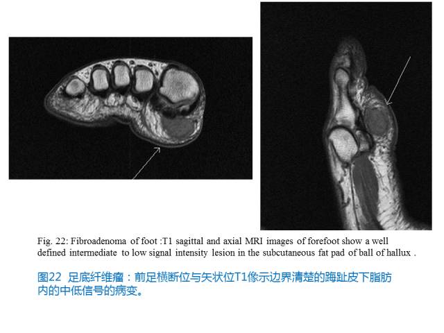 【PPT】前足底痛的MRI诊断