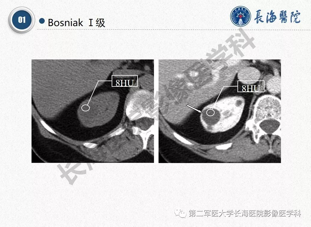 【PPT】肾脏囊性肿块的Bosniak分级,2019版本