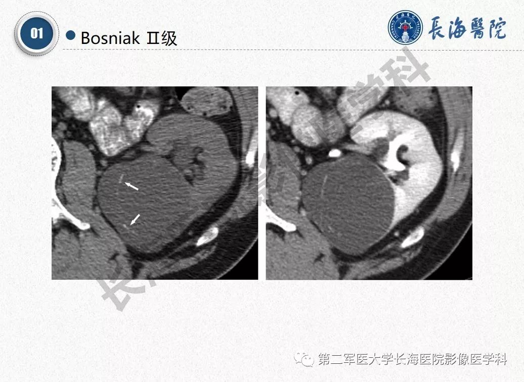【PPT】肾脏囊性肿块的Bosniak分级,2019版本