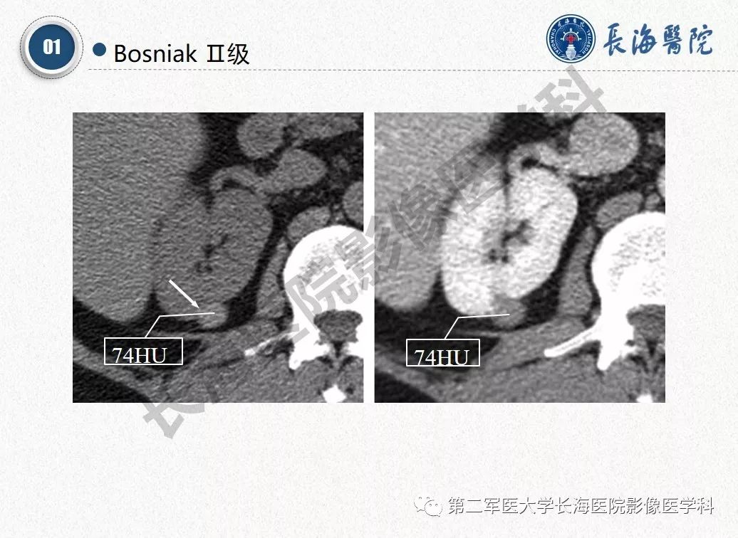 【PPT】肾脏囊性肿块的Bosniak分级,2019版本