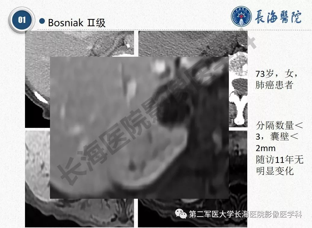 【PPT】肾脏囊性肿块的Bosniak分级,2019版本