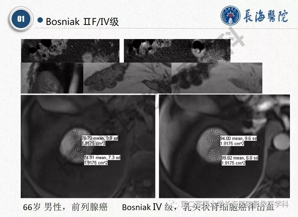 【PPT】肾脏囊性肿块的Bosniak分级,2019版本