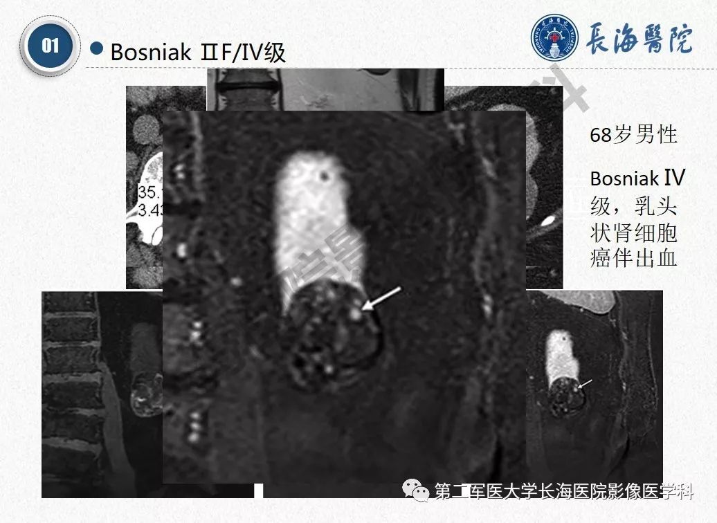 【PPT】肾脏囊性肿块的Bosniak分级,2019版本