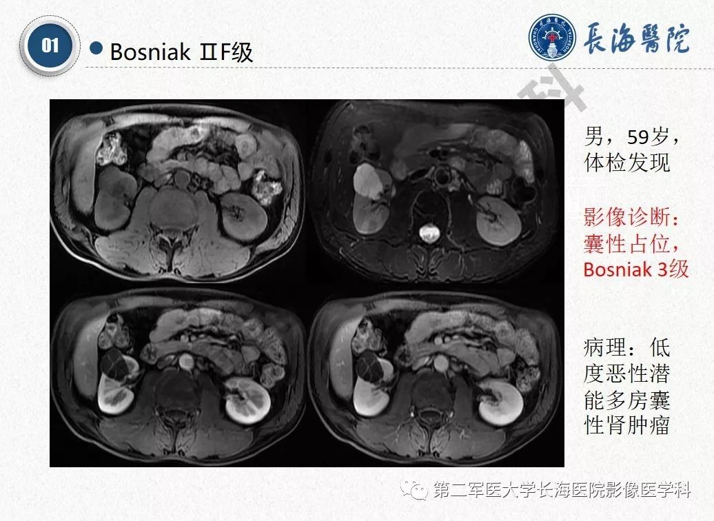 【PPT】肾脏囊性肿块的Bosniak分级,2019版本