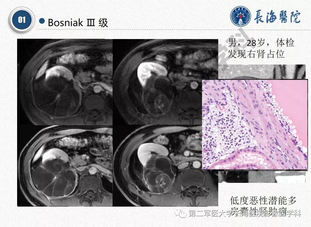 【PPT】肾脏囊性肿块的Bosniak分级,2019版本