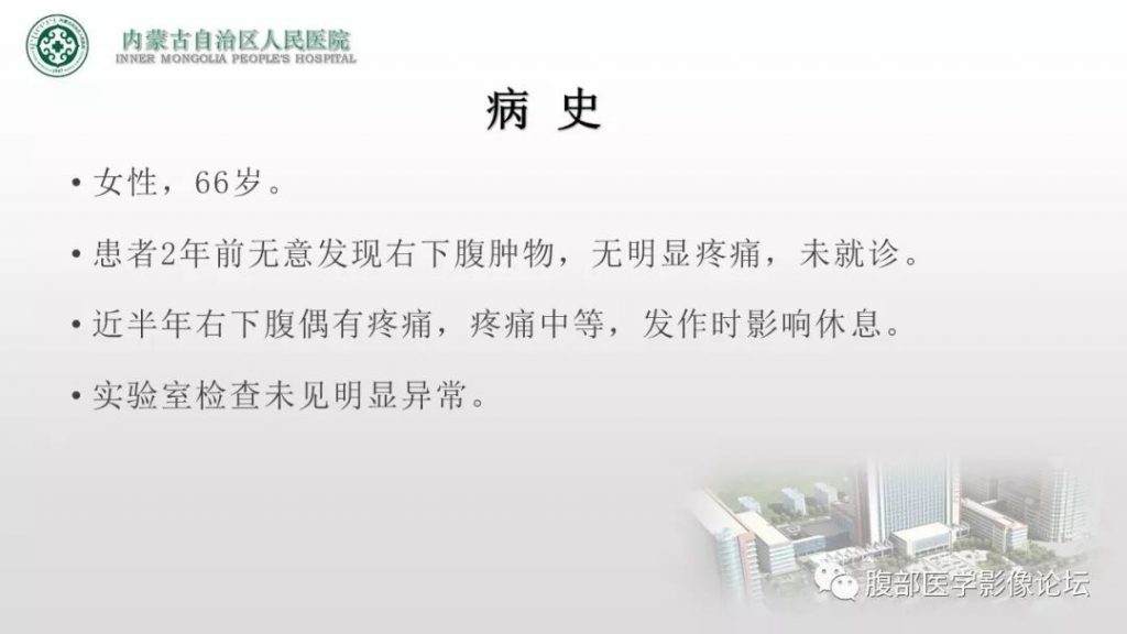 【病例】右侧髂窝腹膜外孤立性纤维瘤1例CT