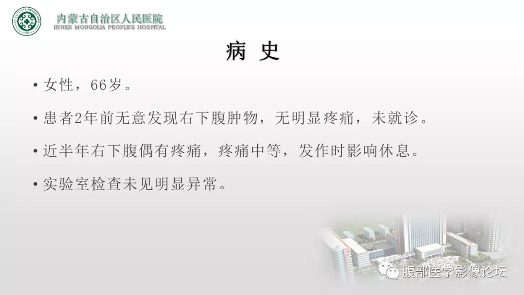 【病例】右侧髂窝腹膜外孤立性纤维瘤1例CT