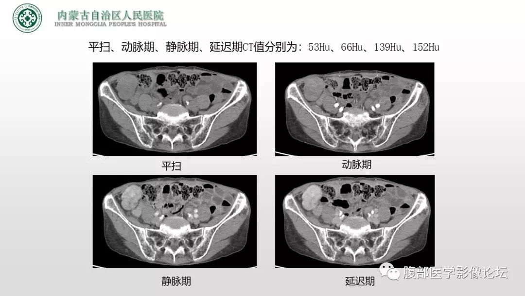 【病例】右侧髂窝腹膜外孤立性纤维瘤1例CT