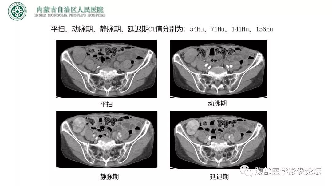 【病例】右侧髂窝腹膜外孤立性纤维瘤1例CT