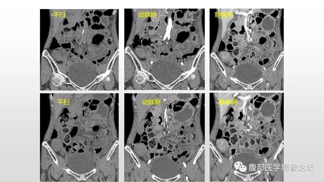 【病例】右侧髂窝腹膜外孤立性纤维瘤1例CT