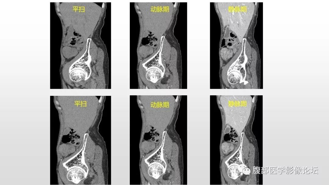 【病例】右侧髂窝腹膜外孤立性纤维瘤1例CT