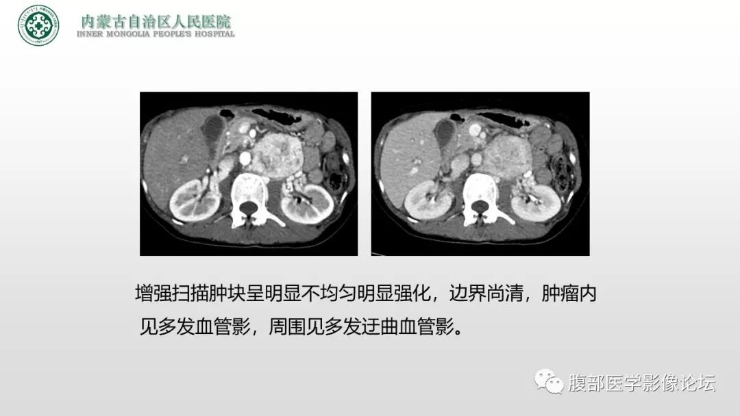 【病例】右侧髂窝腹膜外孤立性纤维瘤1例CT