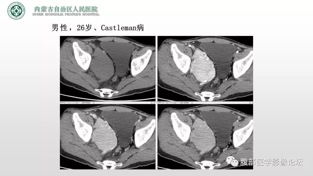 【病例】右侧髂窝腹膜外孤立性纤维瘤1例CT