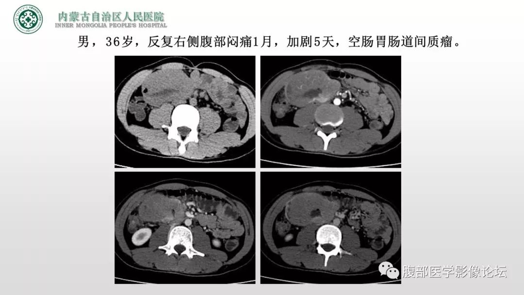 【病例】右侧髂窝腹膜外孤立性纤维瘤1例CT