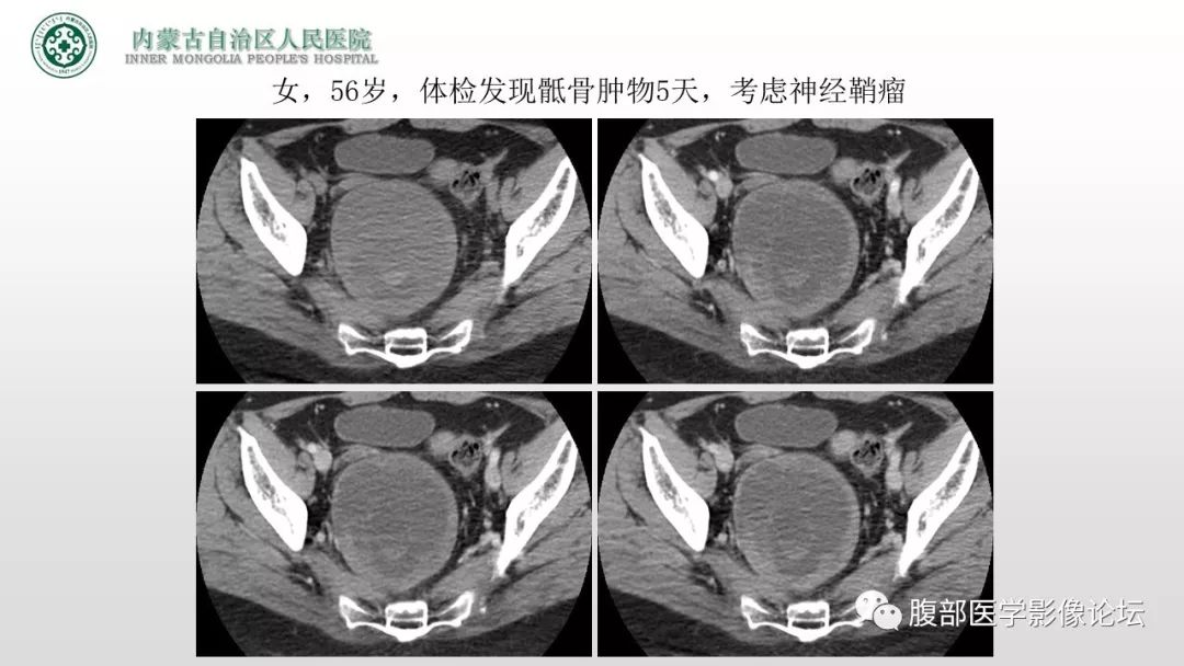 【病例】右侧髂窝腹膜外孤立性纤维瘤1例CT