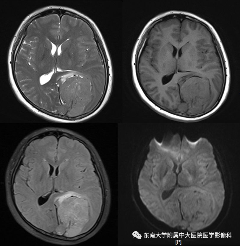 【病例】颅内血管外皮细胞瘤1例MR