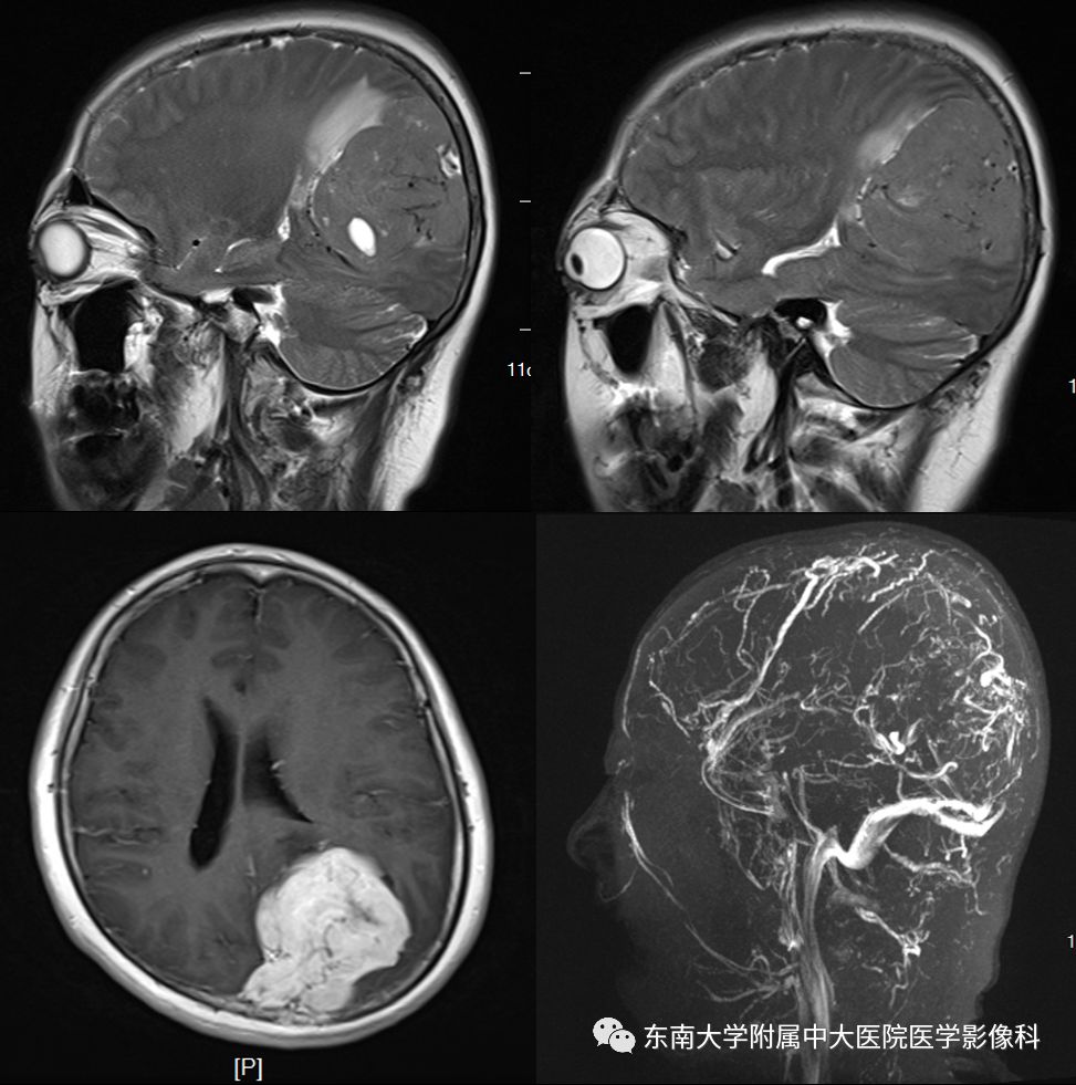 【病例】颅内血管外皮细胞瘤1例MR