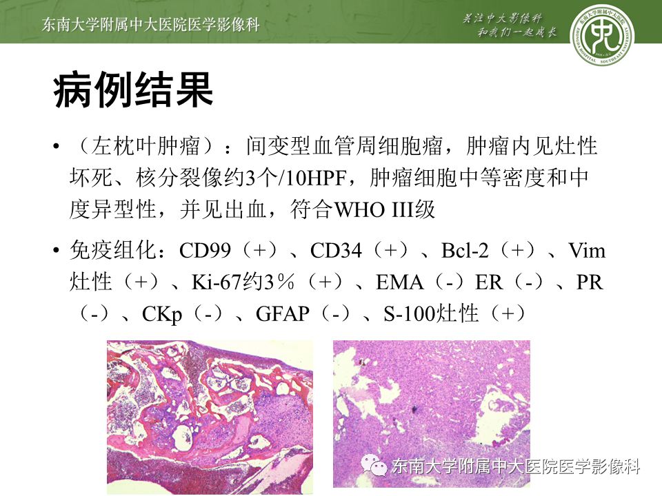 【病例】颅内血管外皮细胞瘤1例MR