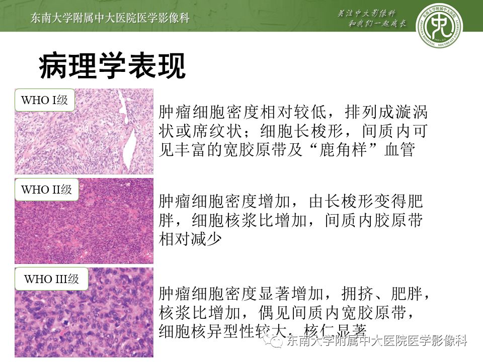 【病例】颅内血管外皮细胞瘤1例MR