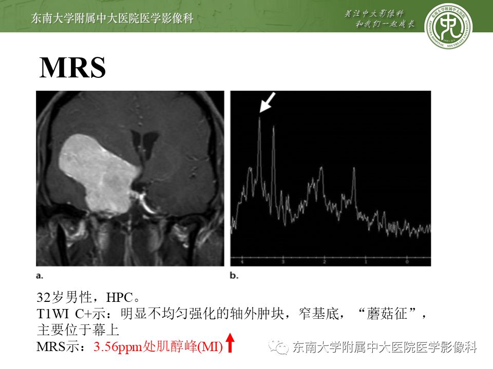 【病例】颅内血管外皮细胞瘤1例MR